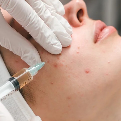 Acne Treatment In Dubai