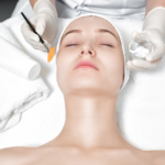 chemical-peel-huddersfield-leeds
