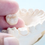 Tooth Crown Dubai