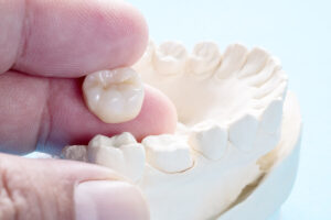 Tooth Crown Dubai
