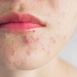 Can Acne Treatment Help Improve the Appearance of Acne Prone Skin