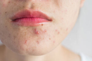 Can Acne Treatment Help Improve the Appearance of Acne Prone Skin
