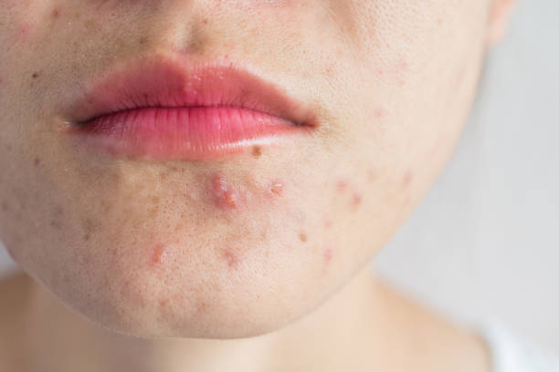 Can Acne Treatment Help Improve the Appearance of Acne Prone Skin