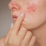 Can Acne Treatment Prevent Future Breakouts