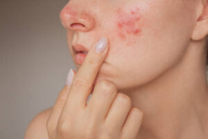 Can Acne Treatment Prevent Future Breakouts