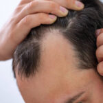 Can GFC Treatment for Hair Help With Receding Hairlines