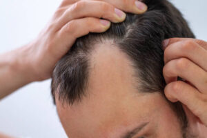 Can GFC Treatment for Hair Help With Receding Hairlines