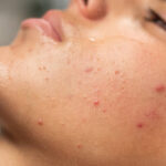 Can Laser Acne Scar Treatment Fade Acne Marks Fast