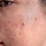 Can Laser Acne Scar Treatment Improve Facial Skin Smoothness