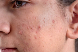 Can Laser Acne Scar Treatment Improve Facial Skin Smoothness