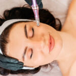 Can Microneedling for Acne Scars Help Restore Smooth Skin Texture