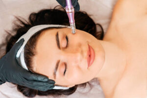 Can Microneedling for Acne Scars Help Restore Smooth Skin Texture