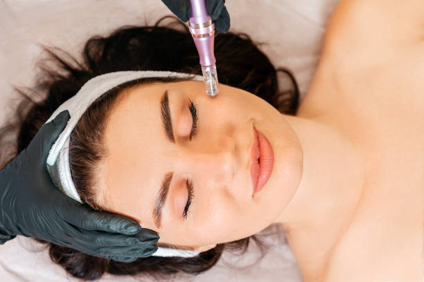 Can Microneedling for Acne Scars Help Restore Smooth Skin Texture