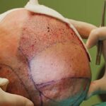 Can SMP Treatment Fix Asymmetrical Hairline Shapes