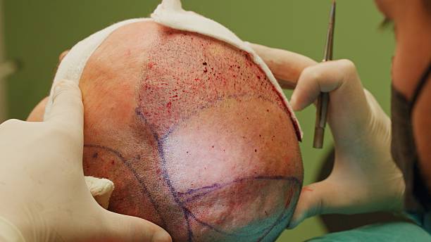 Can SMP Treatment Fix Asymmetrical Hairline Shapes
