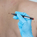 Can Skin Tag Removal Deliver Long-Lasting Results