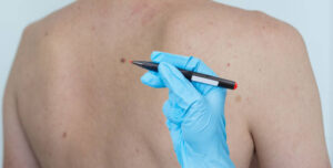 Can Skin Tag Removal Deliver Long-Lasting Results