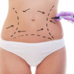Can a Tummy Tuck Deliver Natural-Looking Body Contours