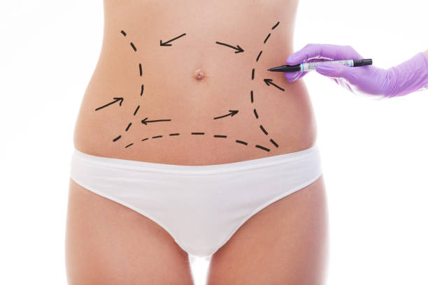 Can a Tummy Tuck Deliver Natural-Looking Body Contours