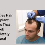 celebrities hair transplant