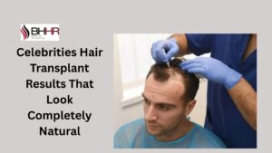 celebrities hair transplant