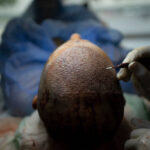 Does FUE Hair Transplant Need Multiple Sessions