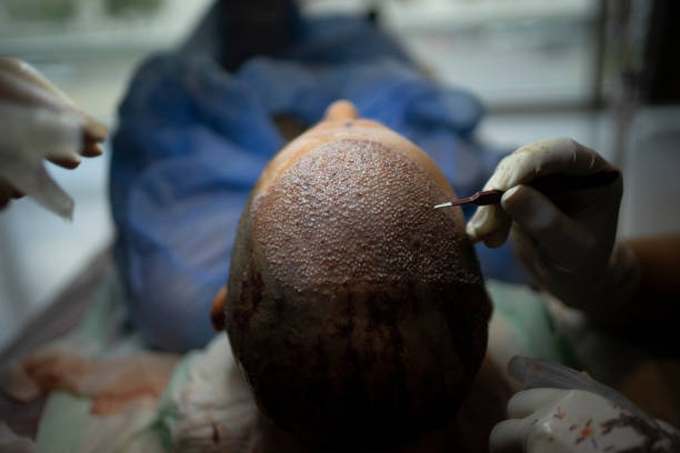 Does FUE Hair Transplant Need Multiple Sessions