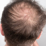 Does Hair Loss Treatment Require Multiple Sessions