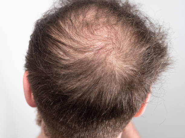Does Hair Loss Treatment Require Multiple Sessions