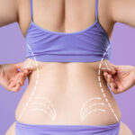 Does Laser Liposuction Reduce Fat Permanently