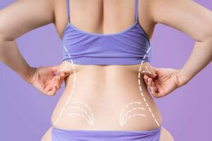 Does Laser Liposuction Reduce Fat Permanently