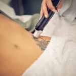 Does Laser Tattoo Removal Leave Any Scars