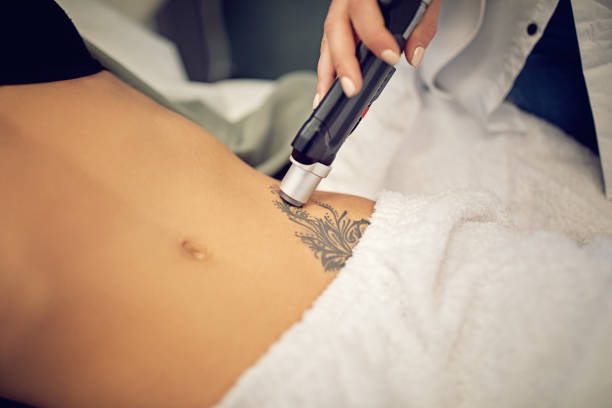 Does Laser Tattoo Removal Leave Any Scars