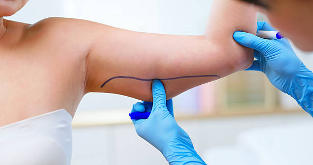 Does Liposuction Work for Arm Fat Removal