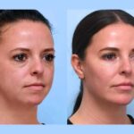 Best Aesthetic Clinic in Dubai Deliver Thread Lift for Natural Results