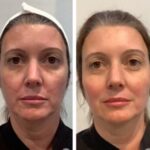 Best Plastic Surgeon in Dubai Offering Innovative PDO Thread Lift Treatment Solutions