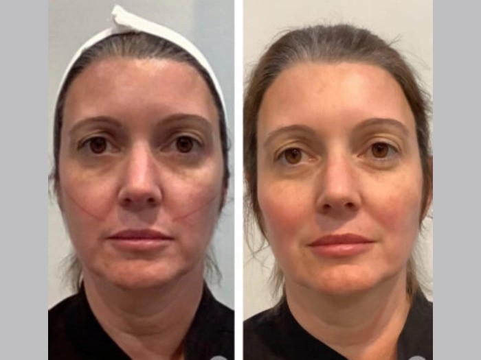 Best Plastic Surgeon in Dubai Offering Innovative PDO Thread Lift Treatment Solutions