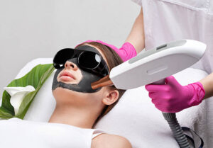 How Does Laser Carbon Peel Improve Skin Tone