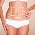 How Does the Best Plastic Surgeon Perform Tummy Tucks