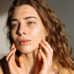 Is Acne Treatment Safe for Sensitive Skin Types