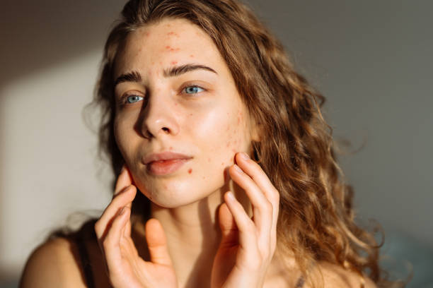 Is Acne Treatment Safe for Sensitive Skin Types