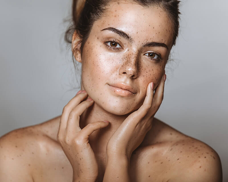 Is Melasma Treatment a Permanent Solution for Pigmentation