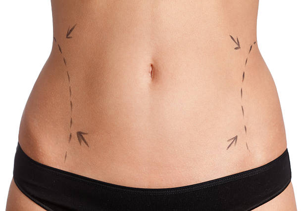 Is Mini Tummy Tuck a Permanent Solution for Belly Skin Laxity