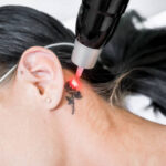 Is Tattoo Removal a Permanent Solution for Unwanted Ink