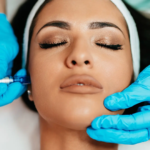 Microneedling Treatment in Fort Lauderdale