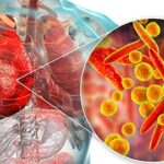 pneumonia and chest infections