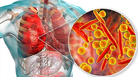 pneumonia and chest infections