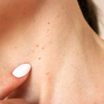 Which Warts Removal Treatment Leaves No Scars