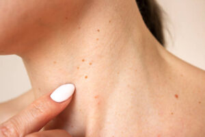 Which Warts Removal Treatment Leaves No Scars