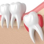 Wisdom-Teeth-min-768x576